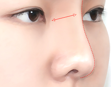 콧대가 너무 높거나 낮은 경우