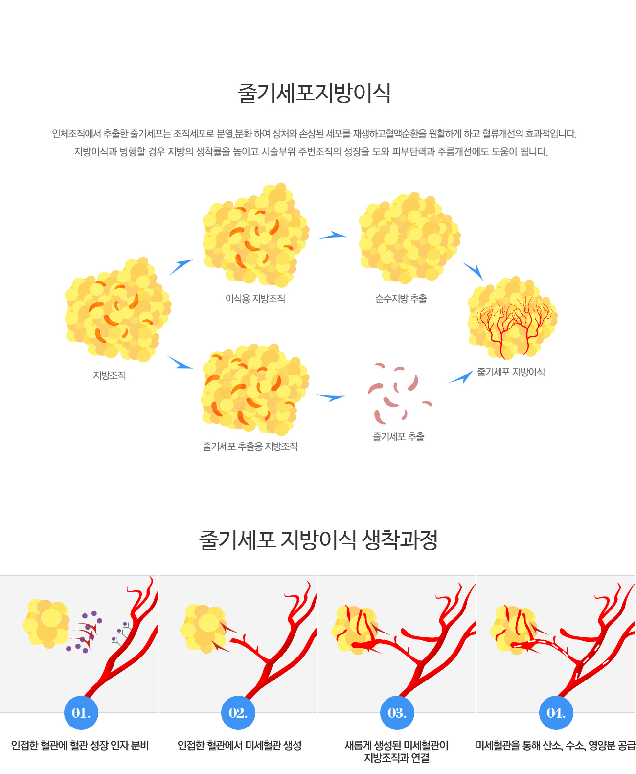 줄기세포 지방이식