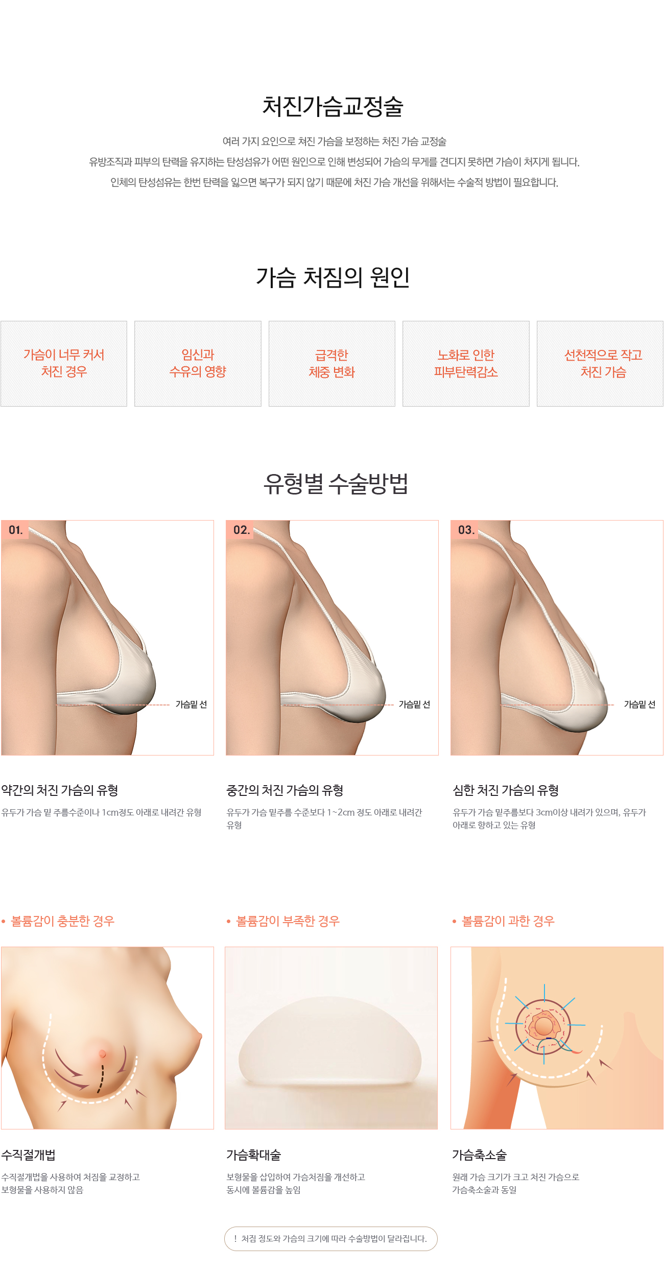 처진가슴교정술