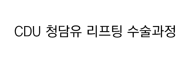 안면거상술